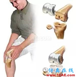 有限元醫學應用案例：全膝關節置換術后通過對股四頭肌肌力進行計算分析來改善患者的膝關節屈曲度hypermesh技術圖片6